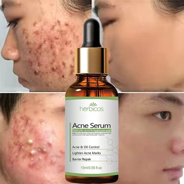 Private Label 2% Salicylic Acid Acne Serum Fast Effective Pimple Treatment Scar Removal Fade Acne Marks Soothe Redness for Face